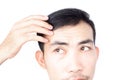 Young man serious hair loss problem for health care medical and shampoo product concept, selective focus Royalty Free Stock Photo