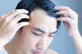 Young man serious hair loss problem for health care medical and shampoo product concept, selective focus Royalty Free Stock Photo