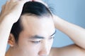 Young man serious hair loss problem for health care medical and shampoo product concept, selective focus Royalty Free Stock Photo