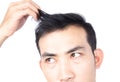 Young man serious hair loss problem for health care medical and shampoo product concept, selective focus Royalty Free Stock Photo