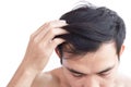 Young man serious hair loss problem for health care medical and shampoo product concept, selective focus Royalty Free Stock Photo