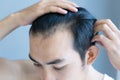 Young man serious hair loss problem for health care medical and shampoo product concept, selective focus Royalty Free Stock Photo