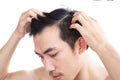 Young man serious hair loss problem for health care medical and shampoo product concept, selective focus Royalty Free Stock Photo