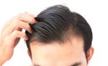 Young man serious hair loss problem for health care shampoo and Royalty Free Stock Photo