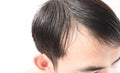 Young man serious hair loss problem for health care shampoo and Royalty Free Stock Photo