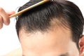 Young man serious hair loss problem for health care shampoo and