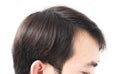 Young man serious hair loss problem for health care shampoo and Royalty Free Stock Photo