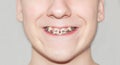 Young man showing crooked growing teeth the dentist and installing braces