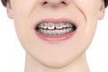 Dental care photo. Crooked growing teeth after visiting the dentist and installing braces. Orthodontics treatment