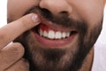 Young man showing inflamed gums, closeup view