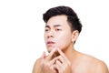 young man Squeezing pimple Royalty Free Stock Photo