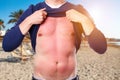 Man with sunburned skin from the sun on the beach Royalty Free Stock Photo