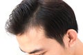 Young man worry hair loss problem for health care shampoo and be Royalty Free Stock Photo