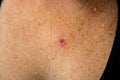 Young 30s caucasian female is anxious aftern superficial basal cell carcinoma skin cancer diagnosis