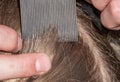 Head lice infection