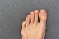 Young white male hairy foot with uncared toe nails