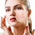 Young woman with acne skin in zoom circle.