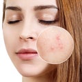 Young woman with acne skin in zoom circle. Royalty Free Stock Photo