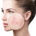 Young woman with acne skin in zoom circle. Royalty Free Stock Photo
