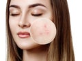 Young woman with acne skin in zoom circle. Royalty Free Stock Photo