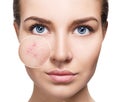 Young woman with acne skin in zoom circle.