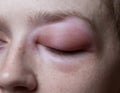 Young woman with allergic reaction on eye Royalty Free Stock Photo