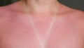 Young woman bare sunburned red chest and neck closeup