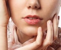 Young woman has chapped lips Royalty Free Stock Photo