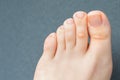 Woman has hard corns and calluses on her toes. Royalty Free Stock Photo