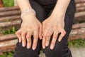 Young woman having rheumatoid arthritis takes a rest sitting on a bench at a yard of a hospital. Hands and legs are deformed.