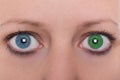 Young woman with heterochromia iridum, two different eye color