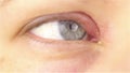 Young woman with hordeolum disease in the eye.