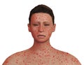 Young woman with measles disease, skin with several red spots and body with fever, isolated on white background