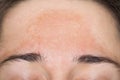 Young woman with pigmented skin on her forehead