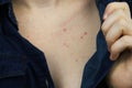 Allergy concept. Young woman with pimples on the chest, closeup