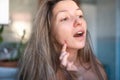 Young woman shows a finger on the red acne on her face. Portrait of a worried woman examining her face. Skin problems Royalty Free Stock Photo