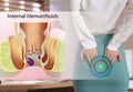 Young woman suffering from hemorrhoid pain in office. Illustration of unhealthy lower rectum