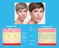 Younger skin and aging skin. elastin and collagen. Royalty Free Stock Photo