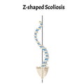 Z-shaped scoliosis. Dextroscoliosis. Levoscoliosis. Spinal curvature, kyphosis, lordosis, scoliosis, arthrosis Royalty Free Stock Photo