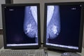 Zagreb, Croatia - June 14, 2017: mammogram results on display fr