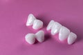 Zircon dentures on a pink background - Ceramic veneers - lumineers