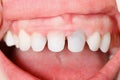 Zircon teeth Royalty Free Stock Photo