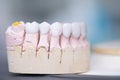 Zirconia dentures on a gypsum jaw - Ceramic dentures - Royalty Free Stock Photo