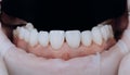 10 Zirconium crown. Dental health care. Zirconium crowns in final version. Staining and glazing. Precision design and