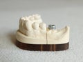 Zirconium or porcelain crown preparation