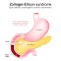 Zollinger-Ellison syndrome. Gastrinoma