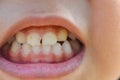 A zoomed-in image captures the mouths of children with misaligned, fractured teeth and odontolith