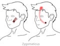 Zygomaticus: managing pain arriving from myofascial trigger points in the face Royalty Free Stock Photo