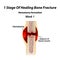 1 Stage Of Healing Bone Fracture. Formation of callus. The bone fracture. Infographics. Vector illustration on isolated