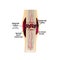 2 Stage Of Healing Bone Fracture. Formation of callus. The bone fracture. Infographics. Vector illustration on isolated